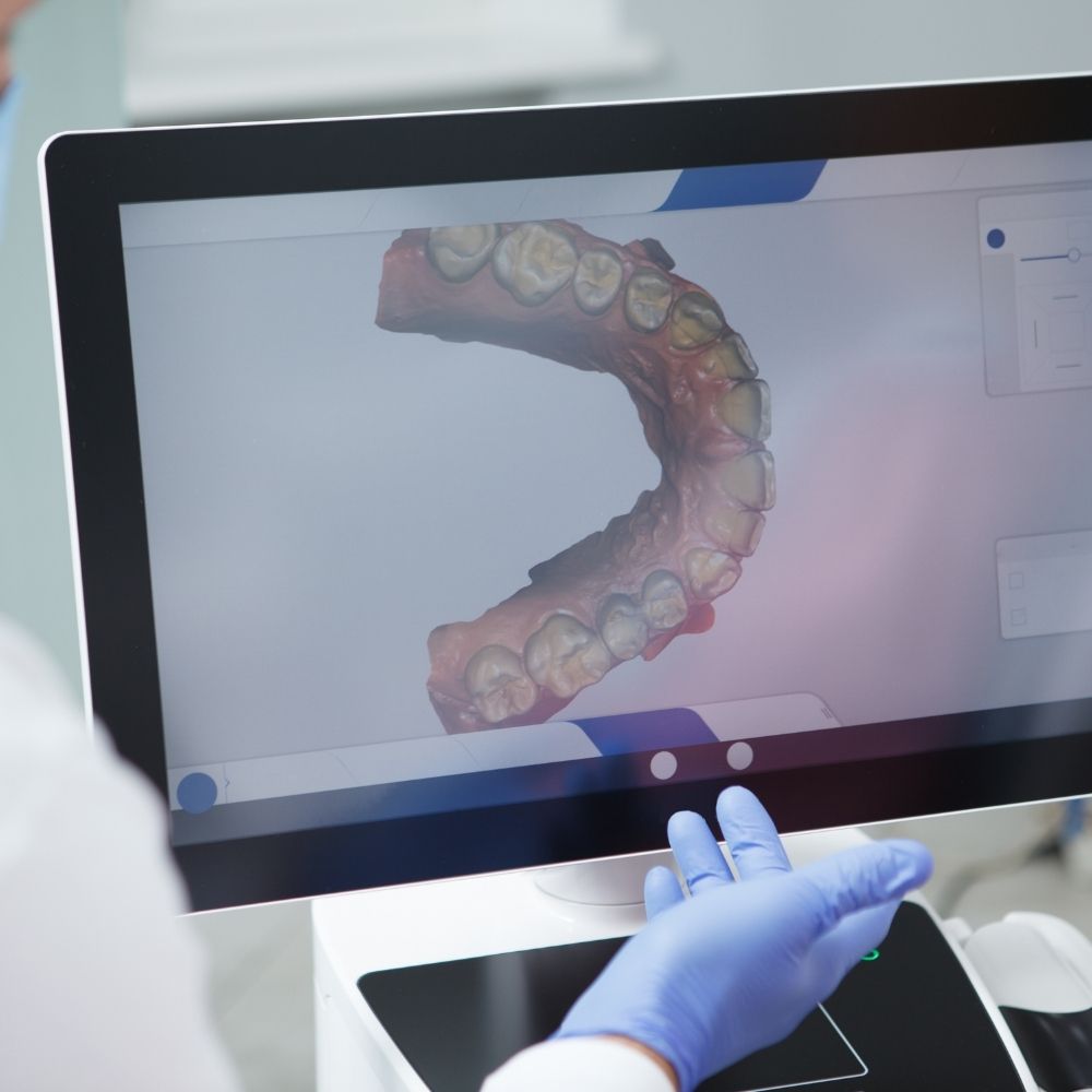 Implantes dentales 5